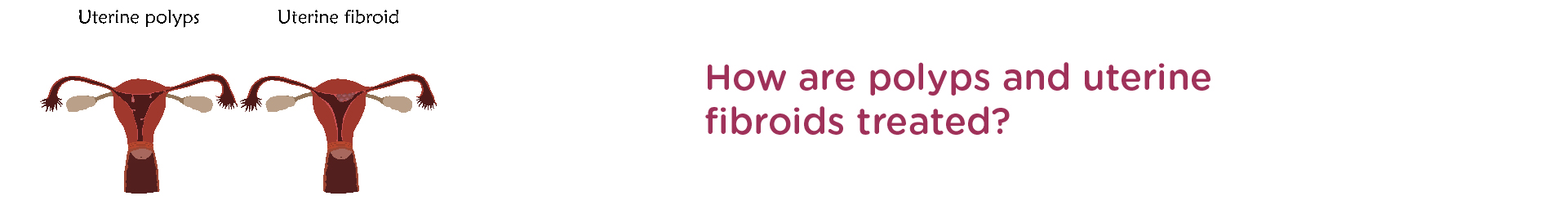 How is polyps and uterine fibroids treated?