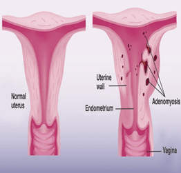Chapter 4 – Adenomyosis – Melaka Fertility